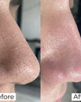 Salicylic Acid Nose Patches