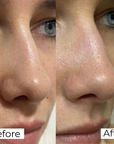 Salicylic Acid Nose Patches