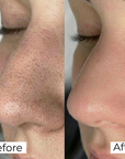 Salicylic Acid Nose Patches