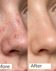 Salicylic Acid Nose Patches